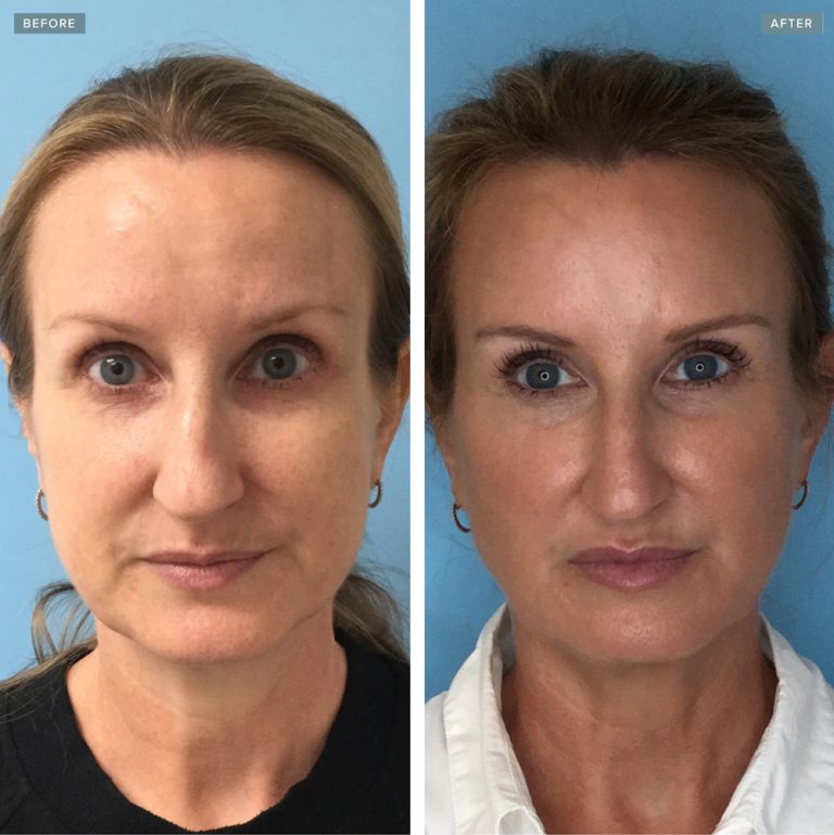 Liquid Facelift OKC | Anti-Aging Experts | Injectable Aesthetics